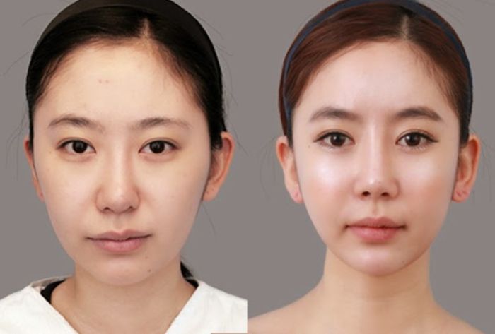 Hút mỡ nọng cằm sau bao lâu thì đẹp