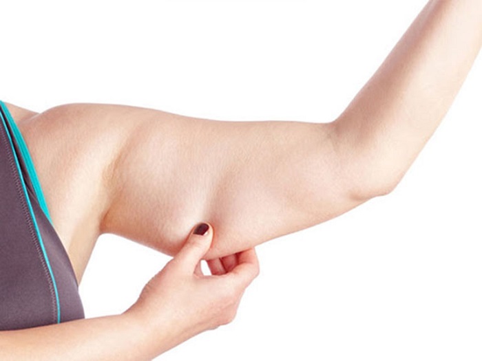 biến chứng hút mỡ bắp tay