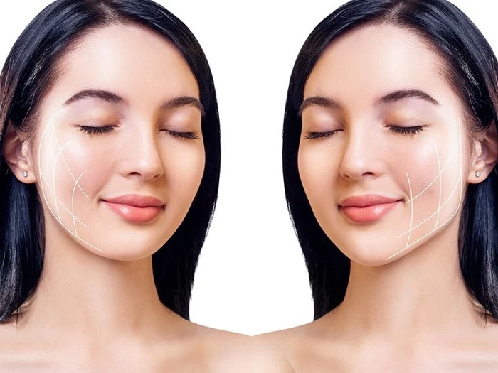 hút mỡ mặt bao lâu hết sưng
