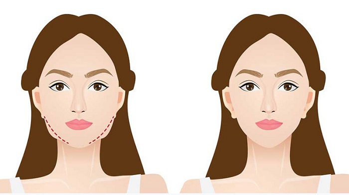 Hút mỡ mặt có nguy hiểm không