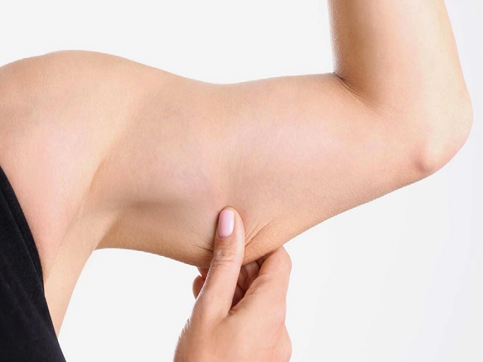 Hút mỡ bắp tay bị lồi lõm