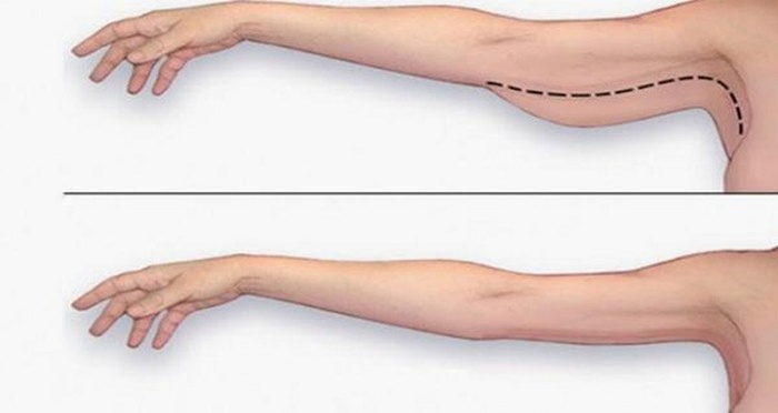 Hút mỡ bắp tay không phẫu thuật