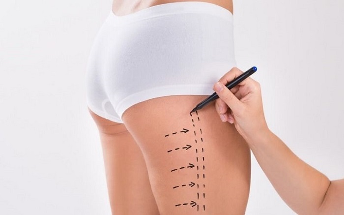 Hút mỡ đùi bao lâu đi lại được