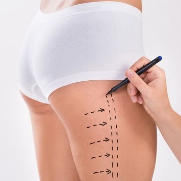 Hút mỡ đùi có nguy hiểm không