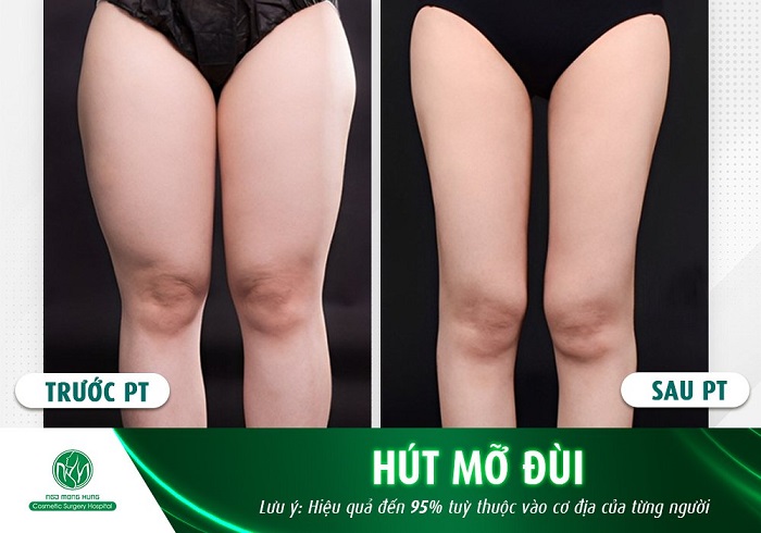 Hút mỡ đùi giá bao nhiêu