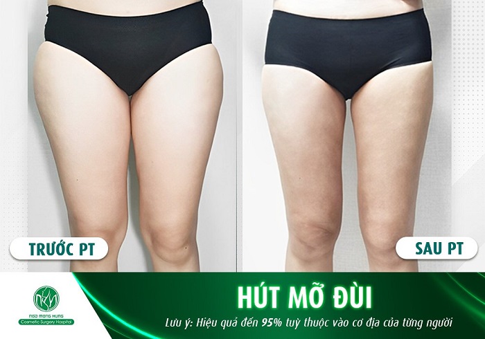 Hút mỡ đùi giá bao nhiêu