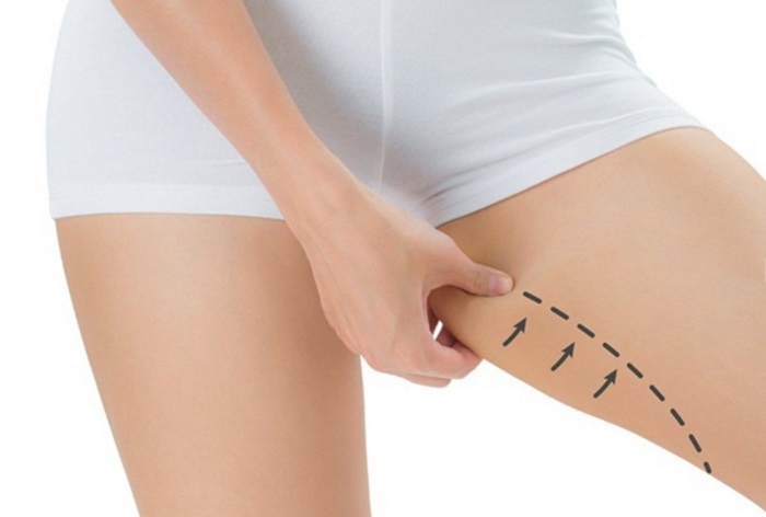 Hút mỡ đùi không phẫu thuật