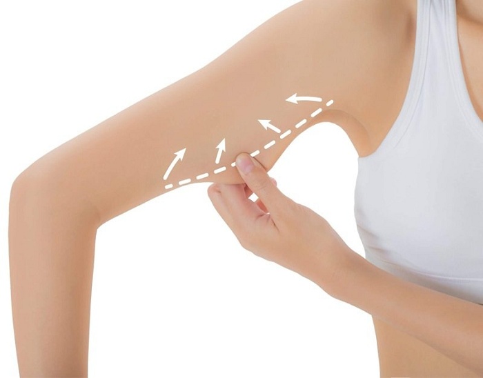 Hút mỡ bắp tay không phẫu thuật