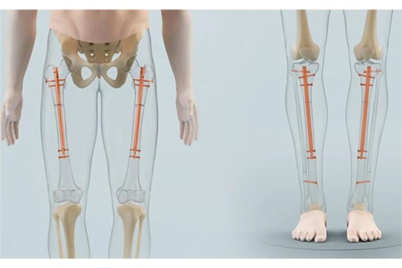 Sự thật: 30 tuổi còn tăng chiều cao được không? 2 Kéo dài chân tăng chiều cao tuổi 30 liệu có hiệu quả?
