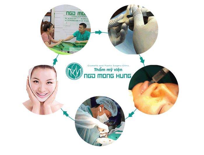Độn cằm v line bao nhiêu tiền