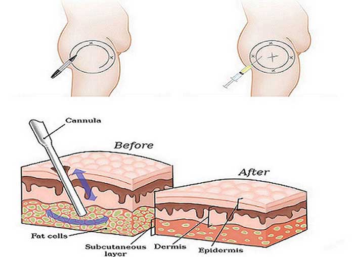 Hút mỡ không phẫu thuật là gì