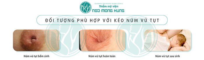 Núm vú bị co kéo tụt vào trong
