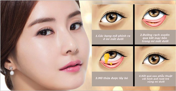 Phẫu thuật bóc mỡ mắt