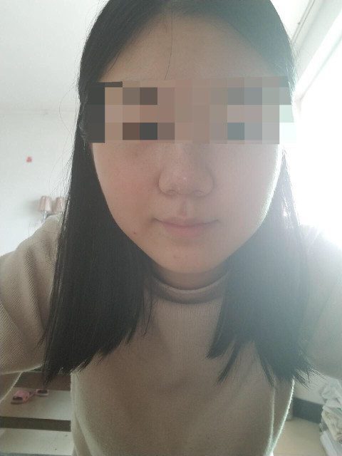 Nâng mũi không phẫu thuật