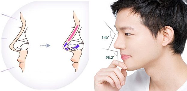 Nâng mũi S Line cho nam