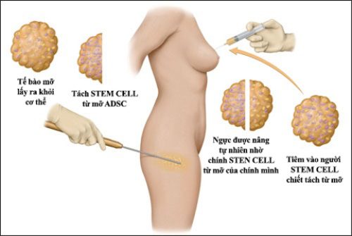 Nâng ngực an toàn bằng mỡ tự thân