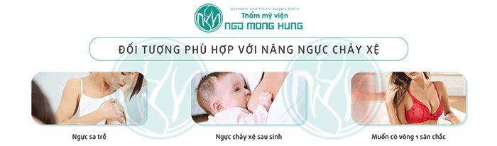 Phương pháp nâng ngực chảy xệ