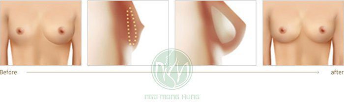 Nâng ngực nội soi 3D