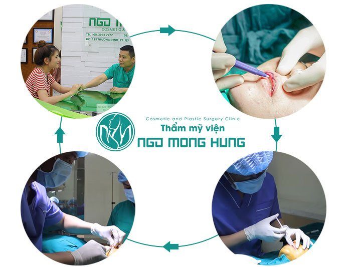 Phẫu thuật sửa môi dày