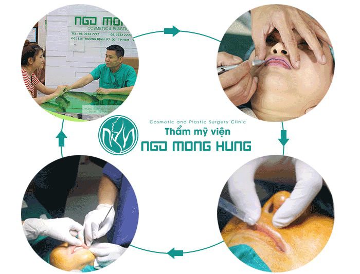 Thu gọn môi dày thành mỏng