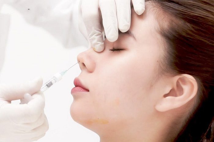 Tiêm filler nâng mũi có tốt không